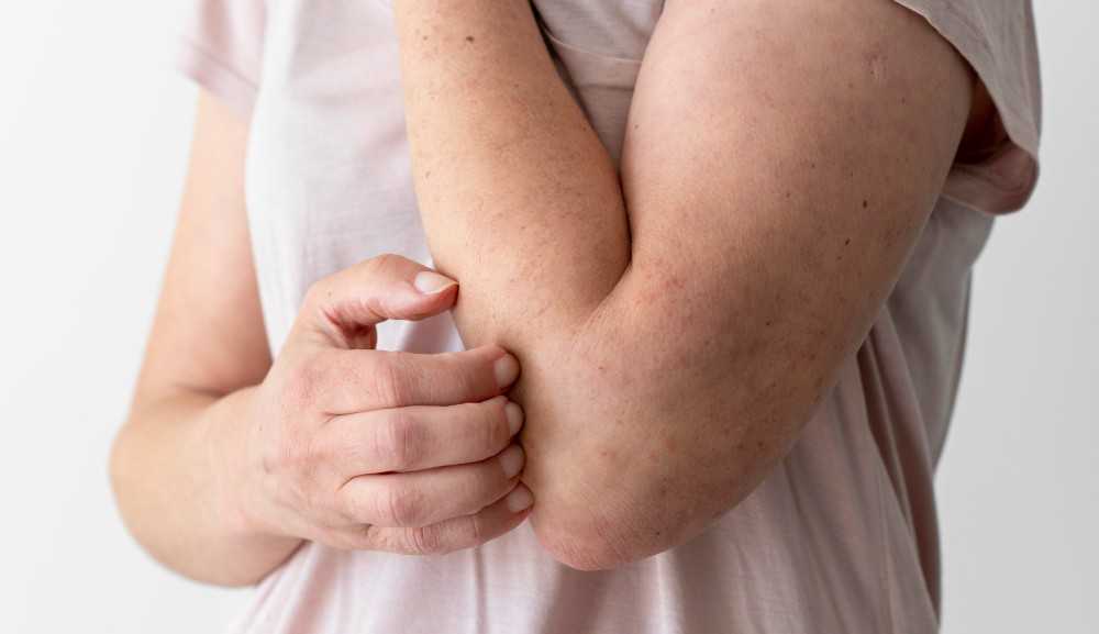 Surto de coceira em Pernambuco foi causado por mariposas, aponta dermatologistas