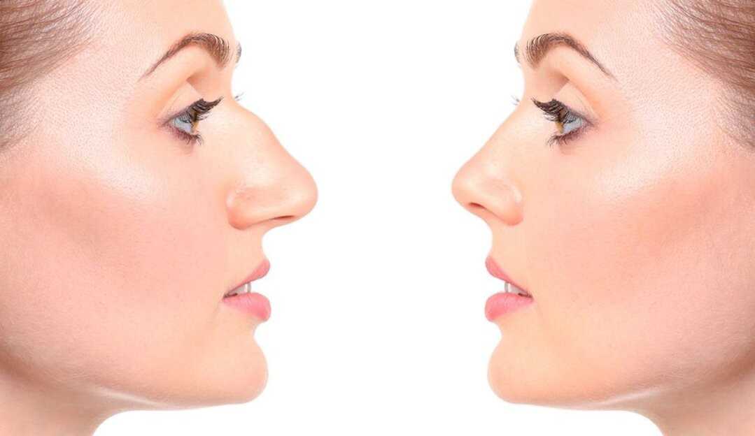 Rinoplastia: saiba tudo sobre a famosa cirurgia do nariz