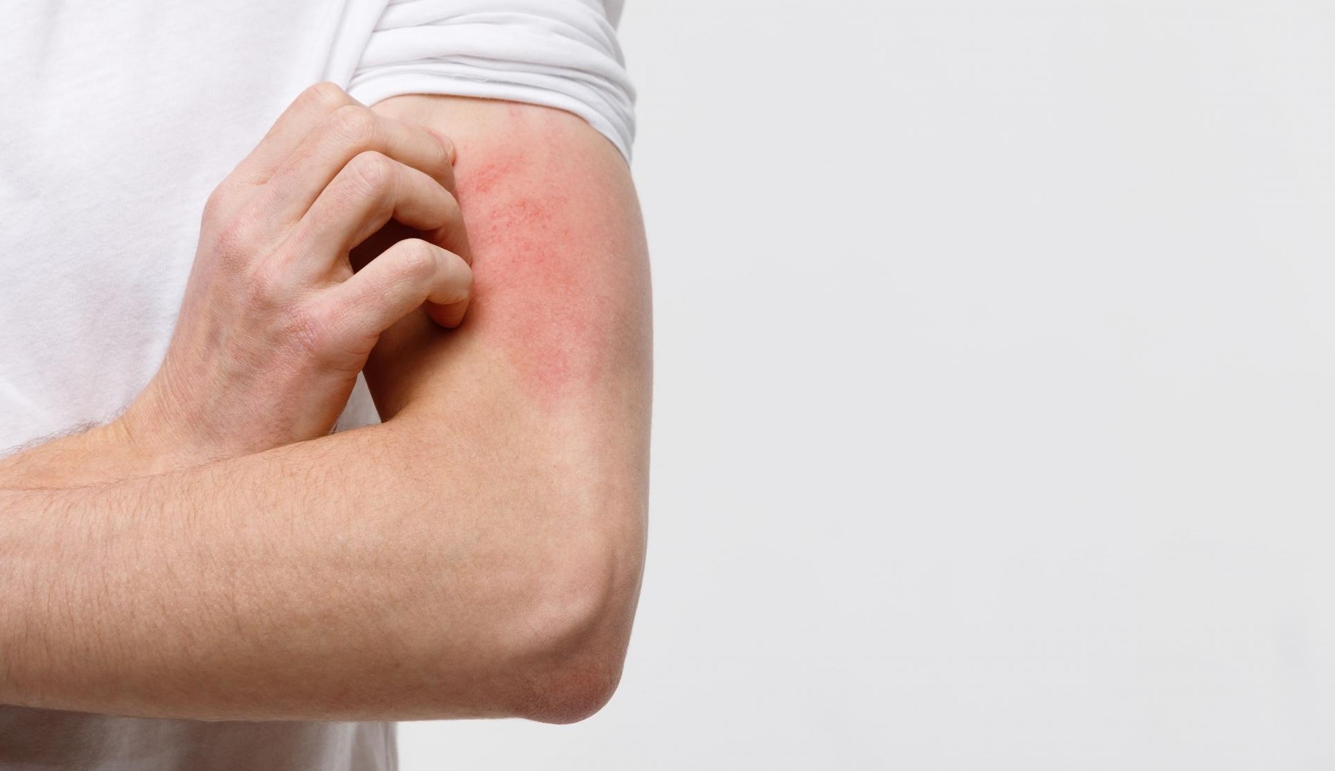 Hanseníase persiste como problema de saúde pública; entenda