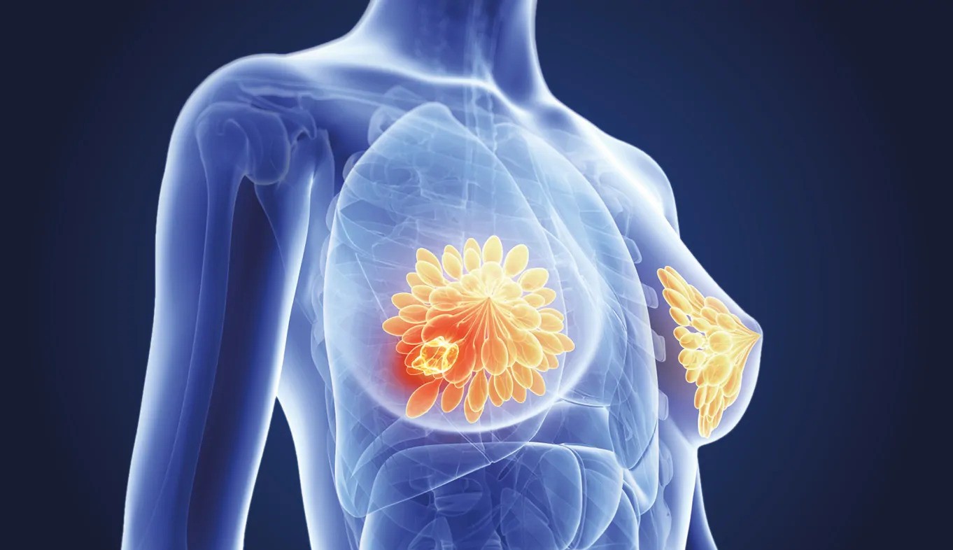 Termografia não deve substituir a mamografia