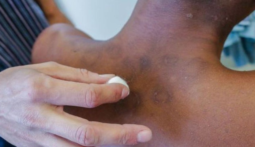 Cientistas desenvolvem inteligência artificial para diagnosticar hanseníase