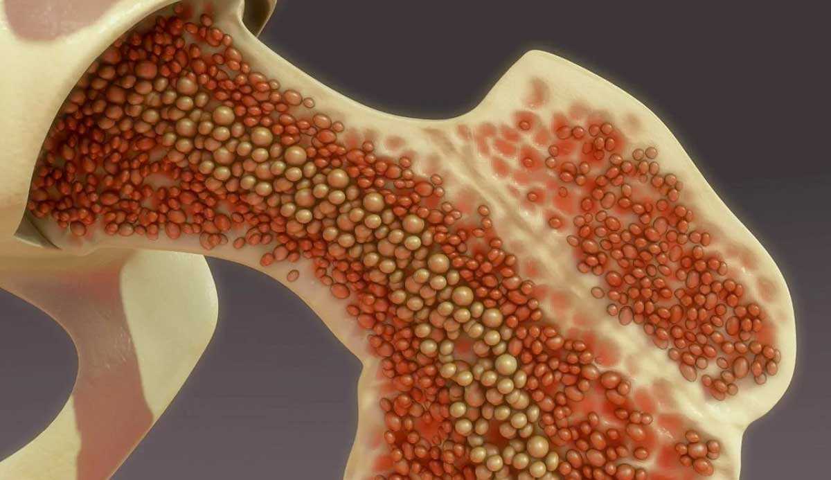 Março borgonha: mês de conscientização para o Mieloma Múltiplo