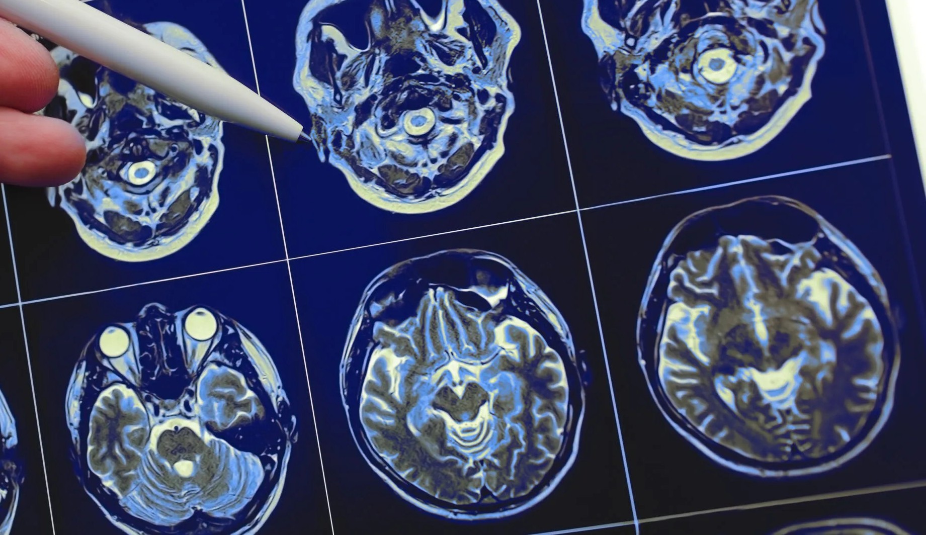 Comunidade médica faz descoberta promissora no tratamento contra Parkinson