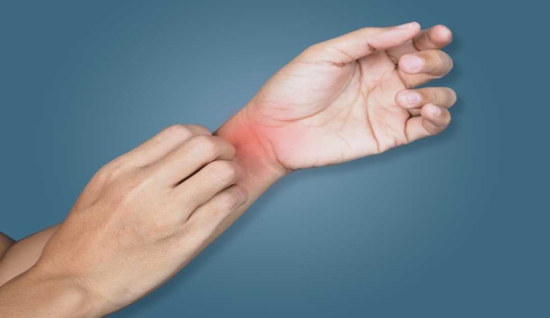 Micose: Saiba o que é e como se prevenir dessa infecção comum no verão