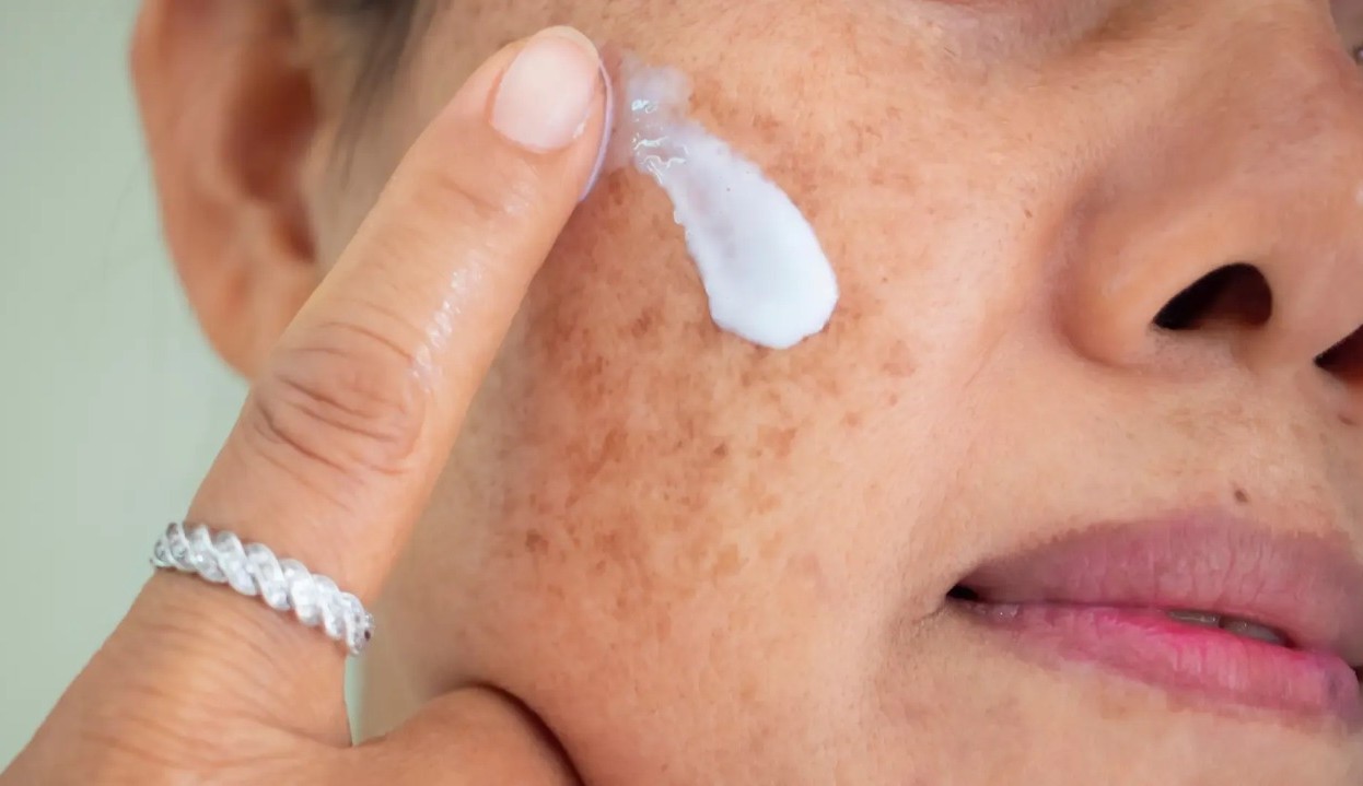 A Influência do estresse no melasma