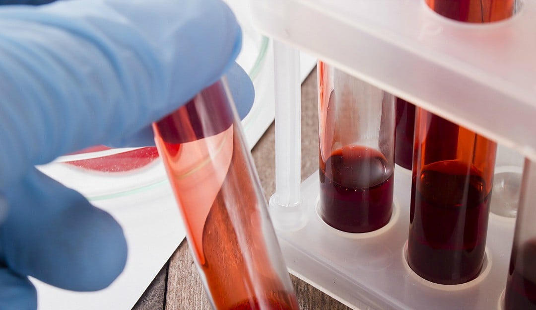 Chega no Brasil o primeiro exame de sangue a avaliar risco do Alzheimer