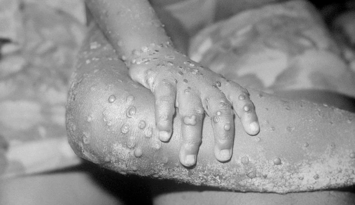 Varíola dos macacos: Entenda o porque o surto na Europa e nos EUA não preocupa tanto a comunidade cientifica