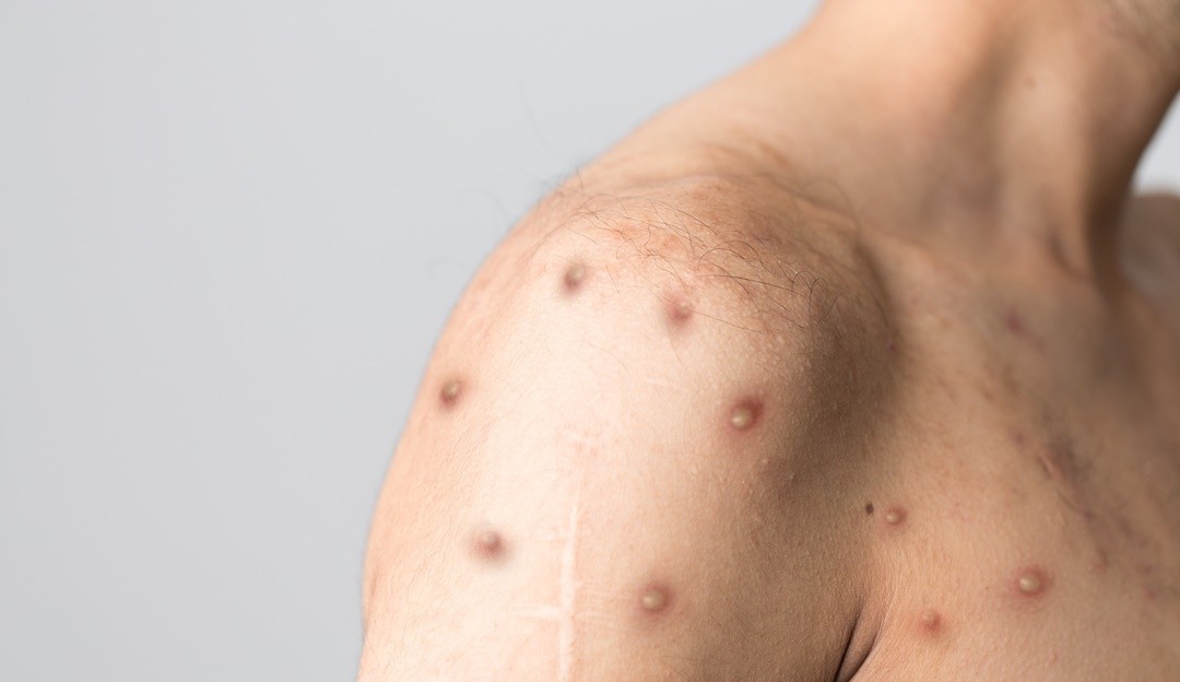 Surto de varíola em macacos na África reacende debate sobre divisão de vacinas igualitária de vacinas entre países