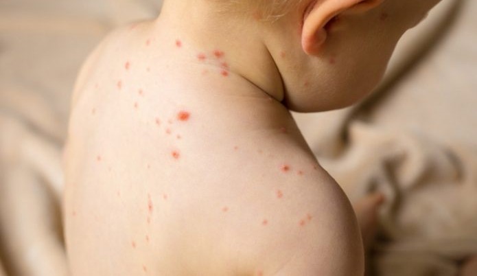 Surto de sarampo e baixa procura por vacinação preocupam OMS