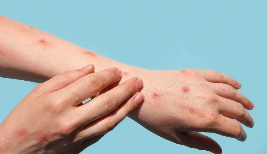 Inglaterra registra transmissão comunitária da varíola dos macacos