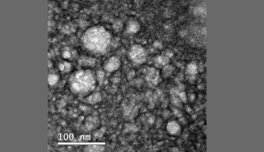 Nova tecnologia é testada contra câncer cerebral