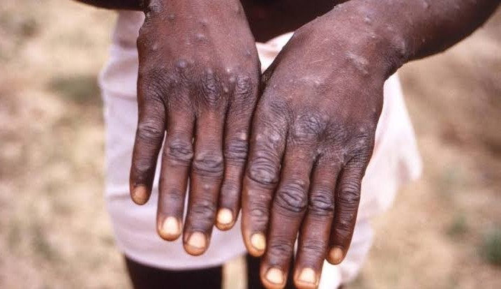 Maranhão é o sexto estado brasileiro a investigar caso suspeito de váriola