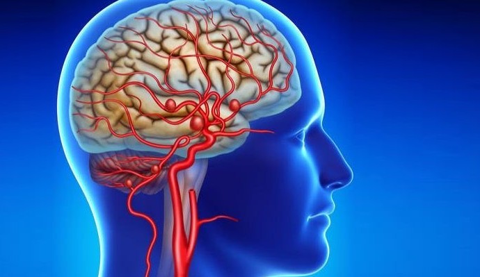 Nova técnica torna tratamento de aneurisma mais seguro
