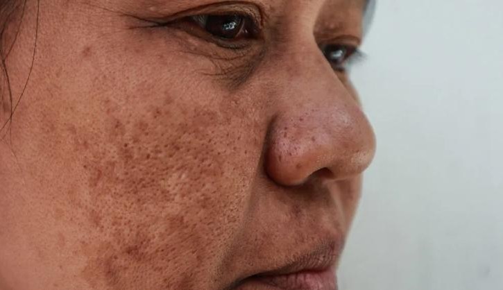 Melasma: conheça as causas e os sintomas da condição