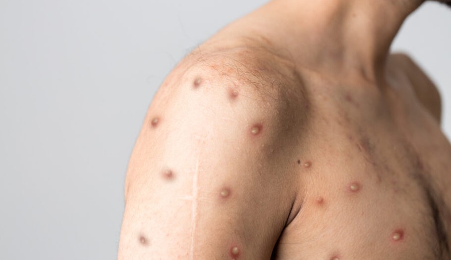 Cinco casos da varíola dos macacos já foram confirmados no Brasil