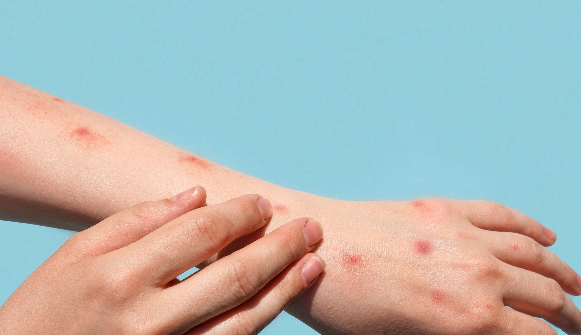 Varíola de macacos: Brasil já registra cinco casos da doença