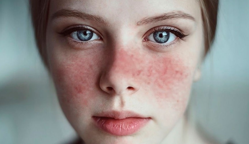 Entenda o que são as doenças autoimunes