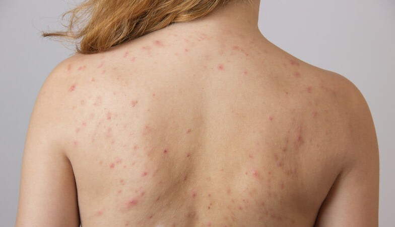 Acne nas costas: dicas de tratamento e prevenção