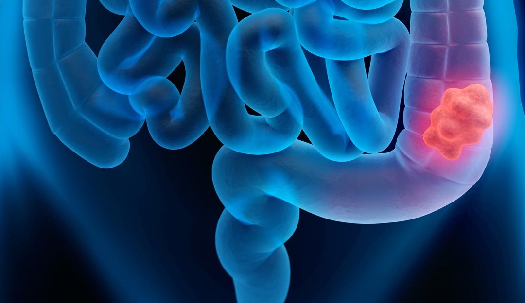 Saiba como reconhecer os sinais e os sintomas de um câncer colorretal