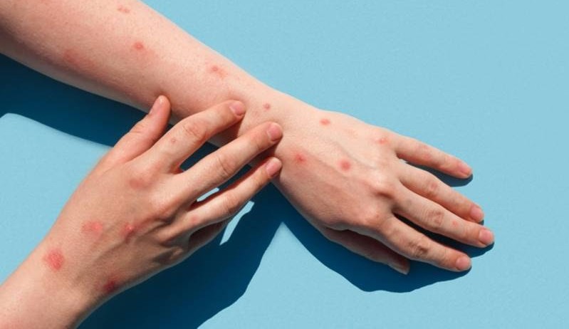 Varíola dos macacos: Sua transmissão ocorre pelo sexo em 95% das vezes