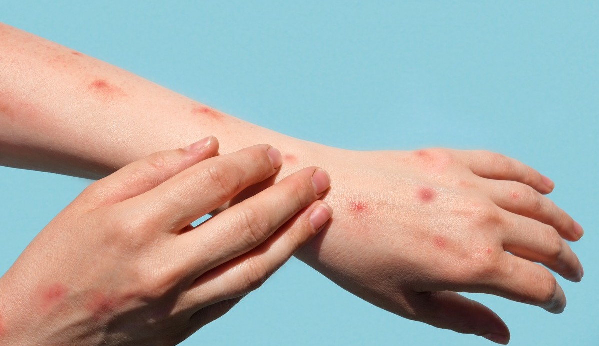 Brasil registra primeiros casos de varíola dos macacos em crianças