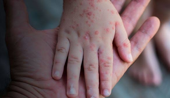 Secretário da Saúde comenta a primeira morte causada pela váriola dos macacos no Brasil