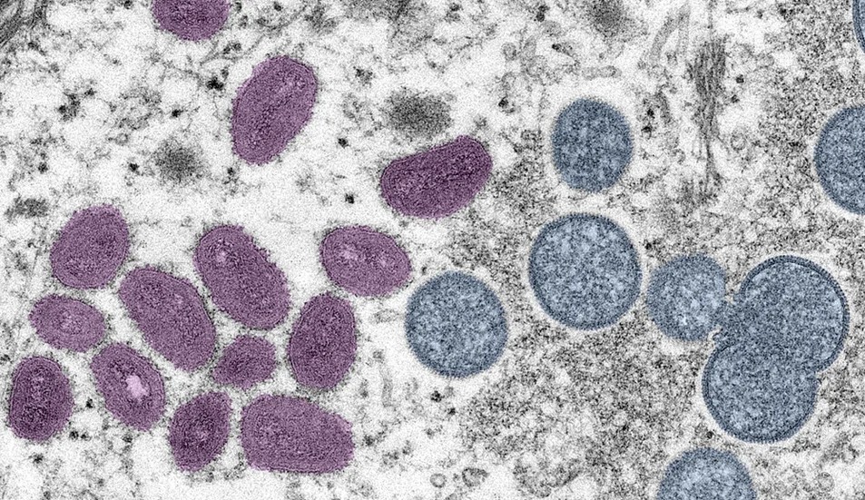 Médico relata caso de um passageiro infectado com Varíola dos Macacos no metro de Madri, Espanha