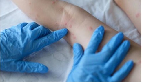 Chefe de estados da Califórnia declara emergência pelo vírus da Varíola do Macaco