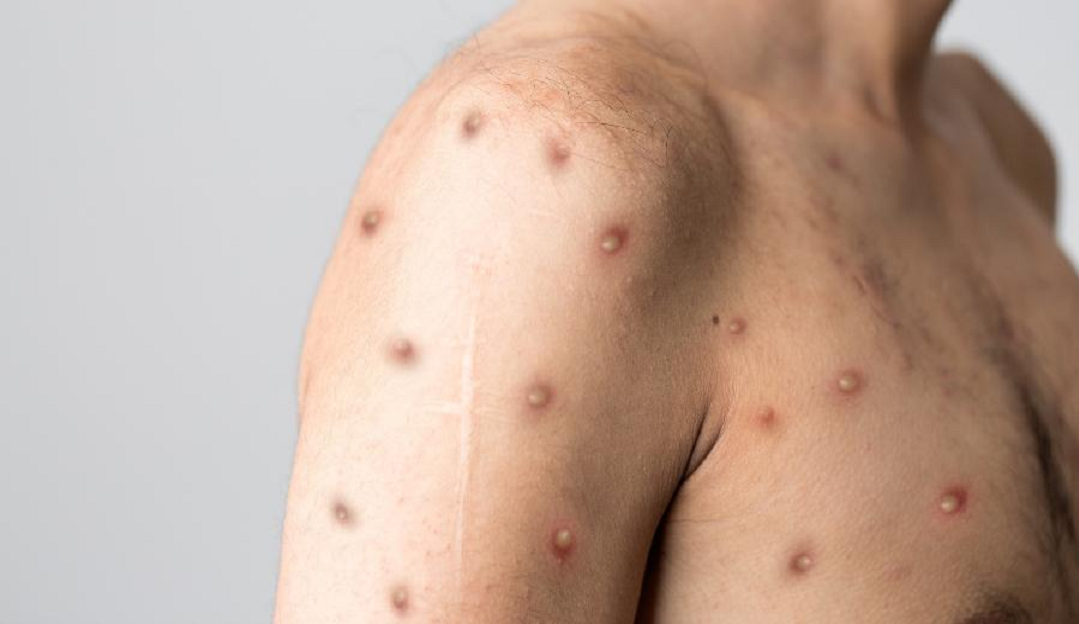 Veja os cuidados com a pele durante os sintomas da varíola dos macacos