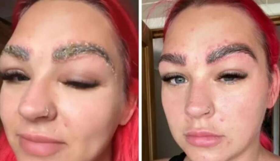 Mulher se prejudica ao fazer um procedimento estético viral do Tik Tok