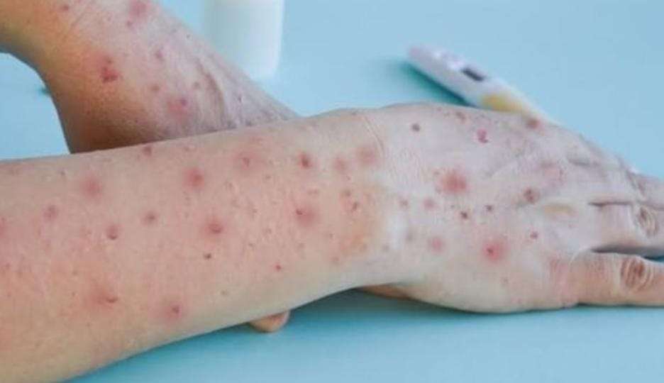 Brasil segue como terceiro país com mais casos da Varíola do Macaco no mundo