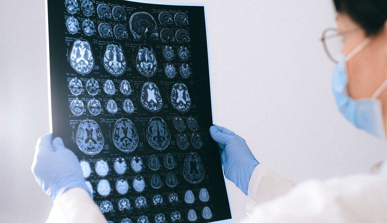 Cientistas descobrem método que pode ajudar a restaurar a perda de memória causada pelo Alzheimer