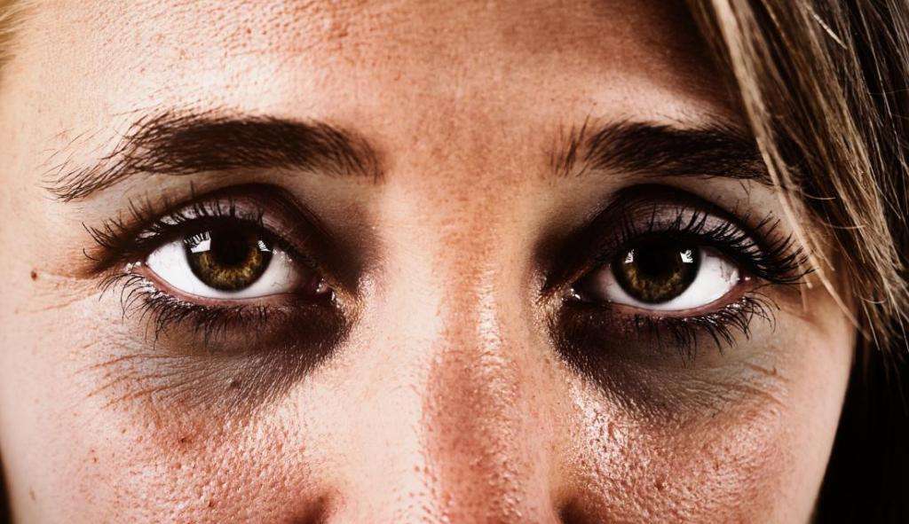 Olheiras: conheça as causas e entenda como diminuir os efeitos da condição
