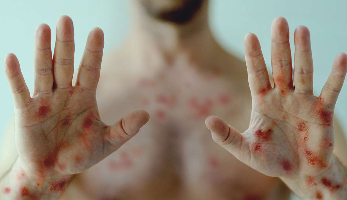 Varíola dos macacos: A doença pode se tornar fatal