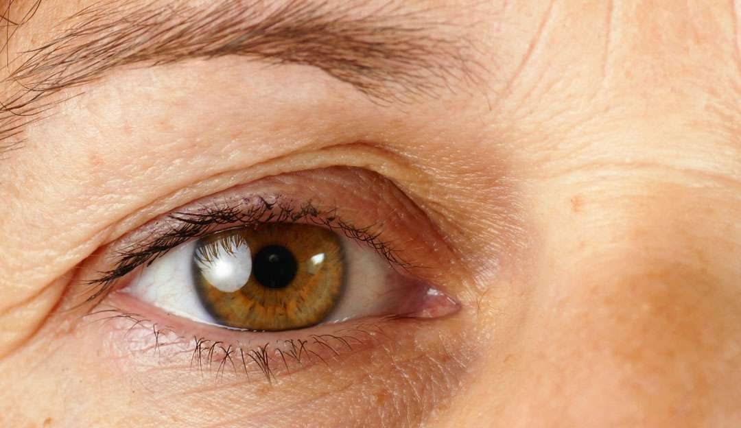 Confira como tratar cada tipo de olheira