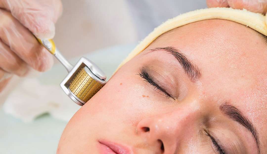 O que é o microagulhamento