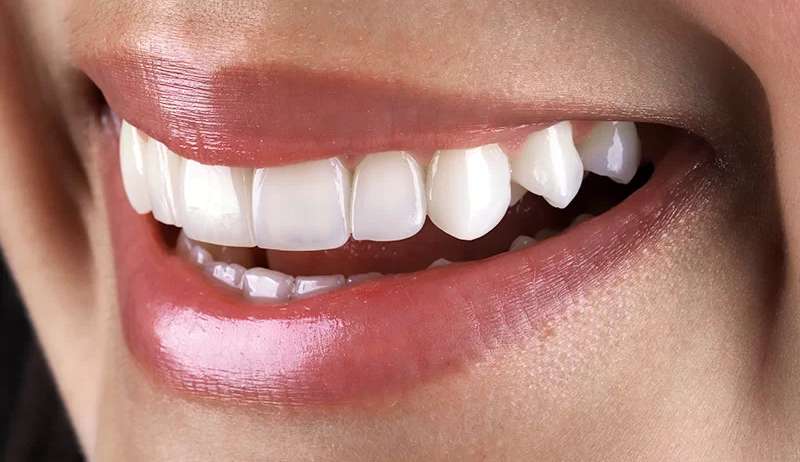 Facetas em resina: Solução prática para seus problemas dentários