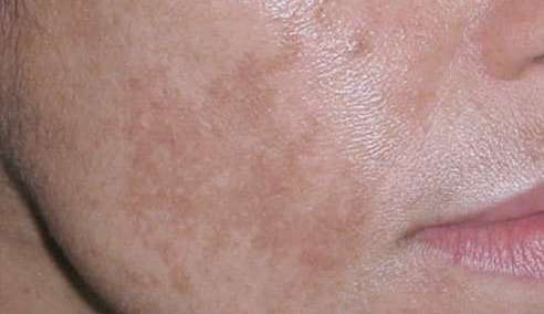 Verdades sobre a hiperpigmentação