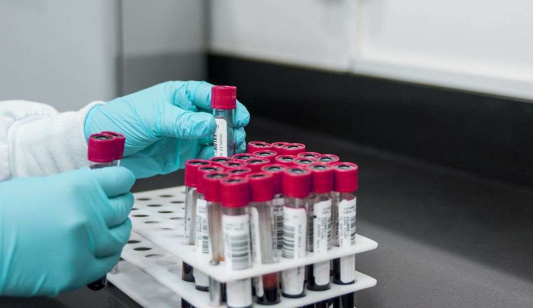 Exame de sangue é capaz de acelerar o diagnóstico de Alzheimer