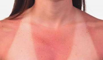 Entenda as principais causas de queimaduras solares e saiba como evitá-las