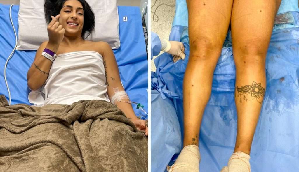 Ex BBB expõe resultado positivo de sua cirurgia de lipedema
