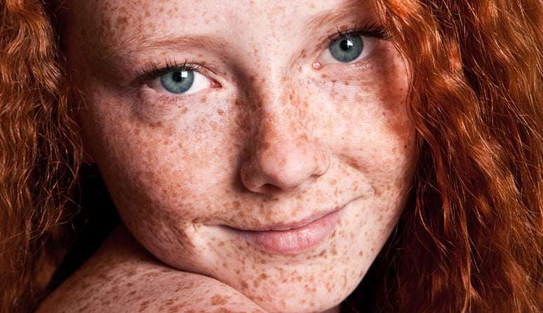 Sardas: o que são e como cuidar