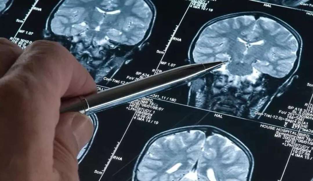 Alzheimer: novo medicamento retarda 35% do avanço da doença