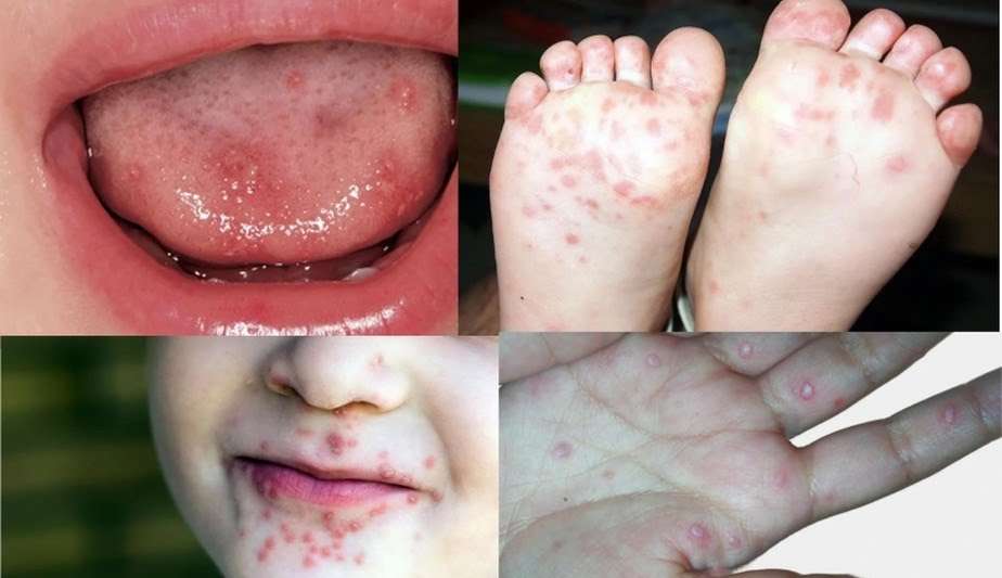 Goiás registra surto da doença mão-pé-boca; saiba como se prevenir