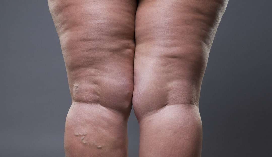 Lipedema: saiba como tratar e identificar doença que atinge mais de 11% das mulheres