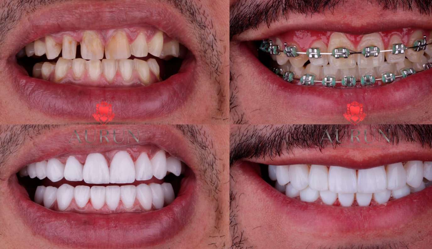 O Poder do Sorriso: Como as Lentes de Contato Dentais Podem Impulsionar a Autoestima