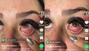 Os perigos da extensão de cílios: Jovem contrai conjuntivite química e caso se torna viral
