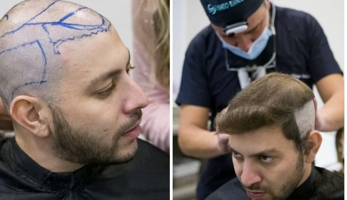 “/Me incomodava muito”/ diz ex-BBB Caio Afiune após fazer transplante capilar