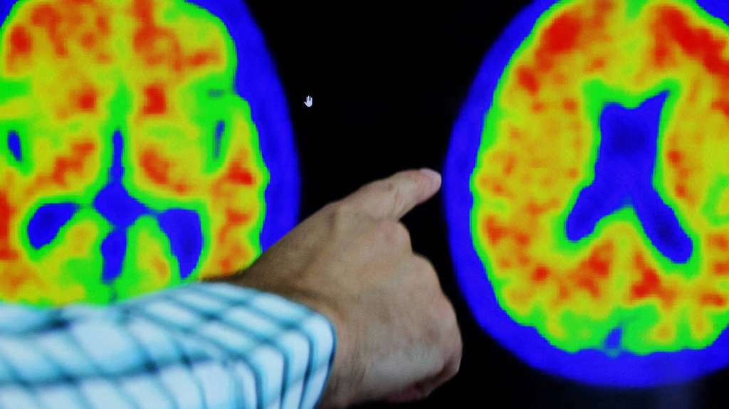 Alzheimer: Nova droga reduz em até 60% a progressão da doença