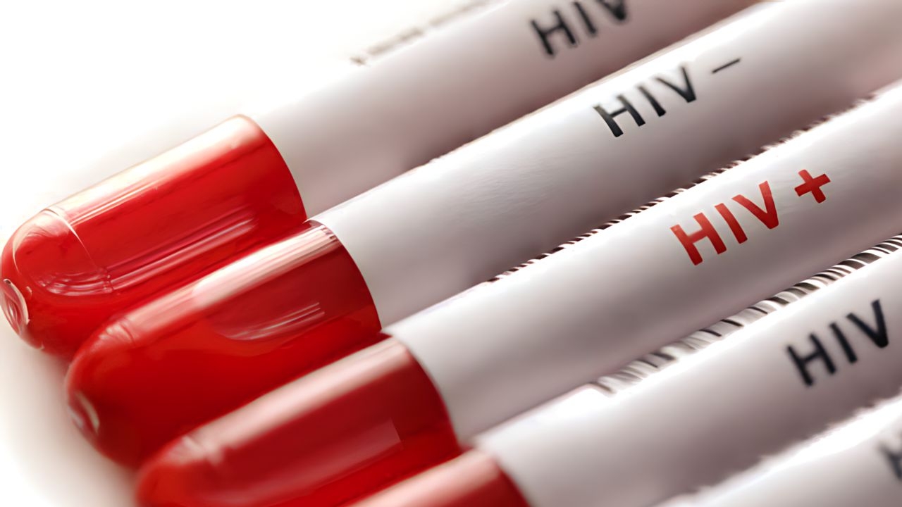 Paciente entra em remissão do HIV após receber transplante para tratar câncer